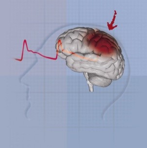 Setmana del Cervell: Accidents de trànsit i traumatismes cranials